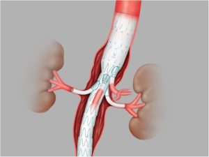 Endoprótese Endovascular Toracoabdominal Zenith T-BRANCH