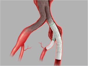 Endoprótese Endovascular Ramificada de Ilíaca Zenith® Branch
