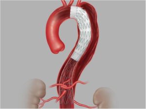 Endoprótese Torácica Zenith® TX2® Dissection